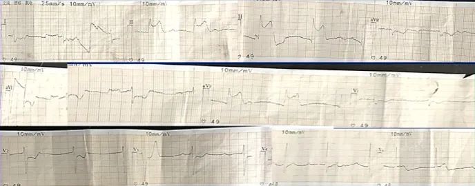 主动脉夹层真假腔鉴别超声示意图,主动脉夹层诊断中国专家共识