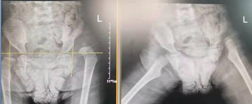 湖南省儿童医院先天性髋关节脱位,幼儿髋关节脱位切开复位和断骨