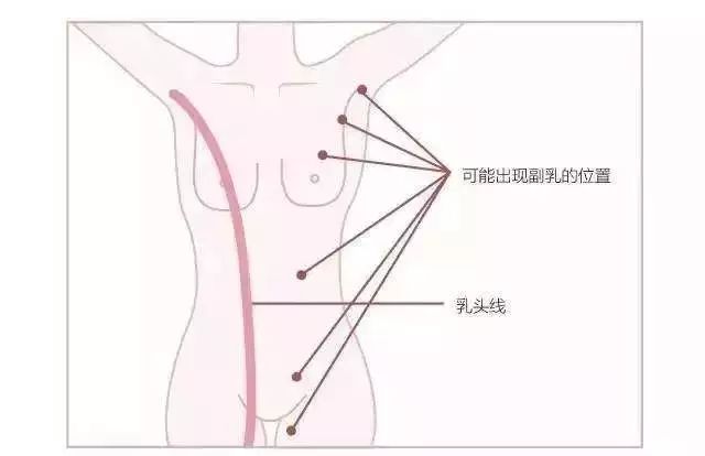 腋下脂肪堆积的副乳怎么去除,消除副乳手臂赘肉