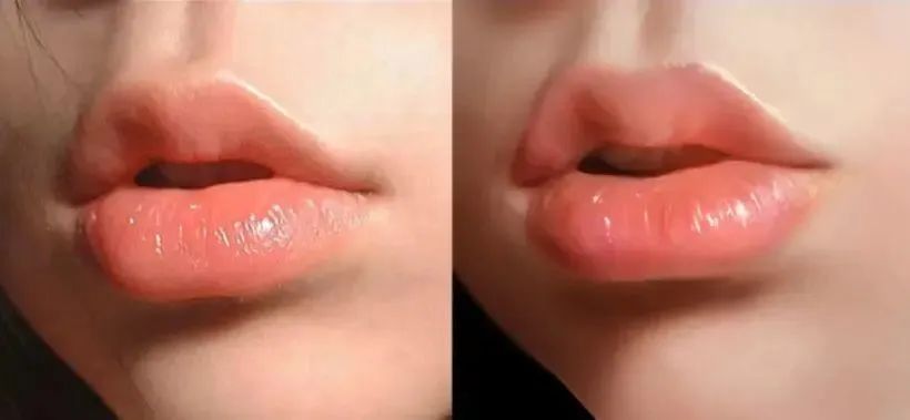 嘴唇干裂起皮等皮掉了涂唇膏,嘴唇干脱皮用什么唇部护理比较好?