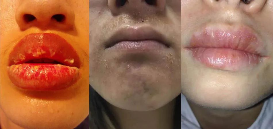 拒绝皮肤干裂带来的尴尬,唇部保养tips教程