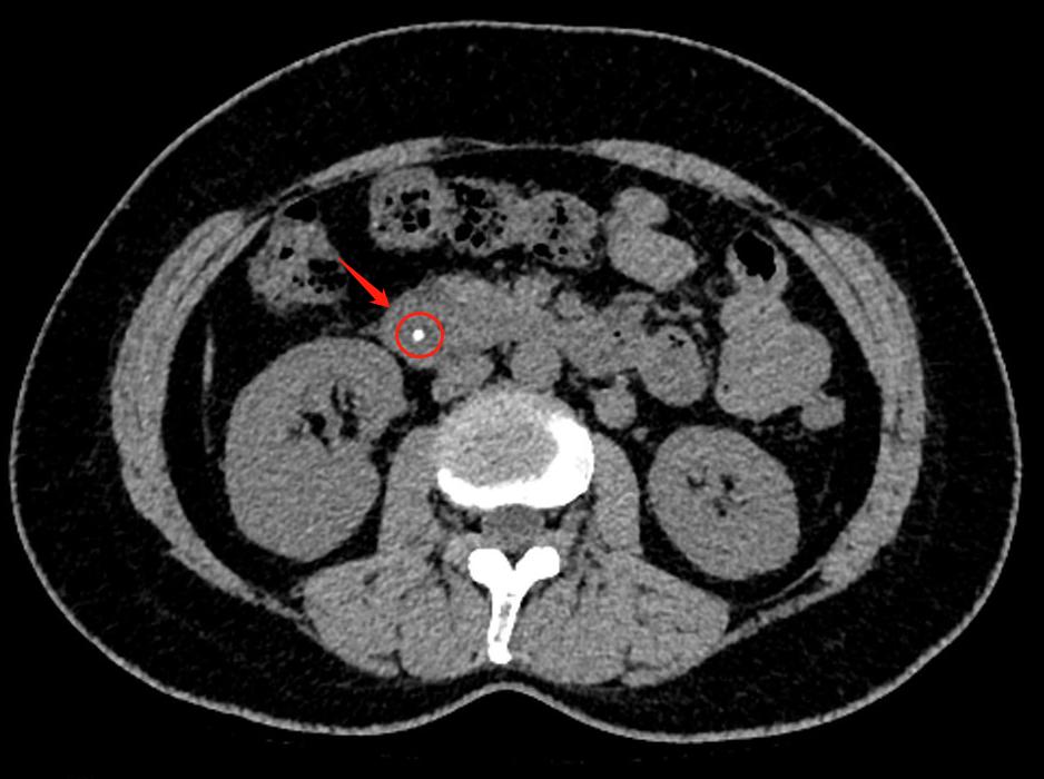 女子体内活虫蠕动只因爱吃这道菜,女子体内取出活虫只因爱吃这样菜