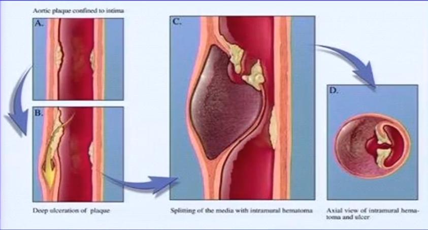 胸痛的诊断与鉴别诊断心得,急性胸痛的诊断思路和方法
