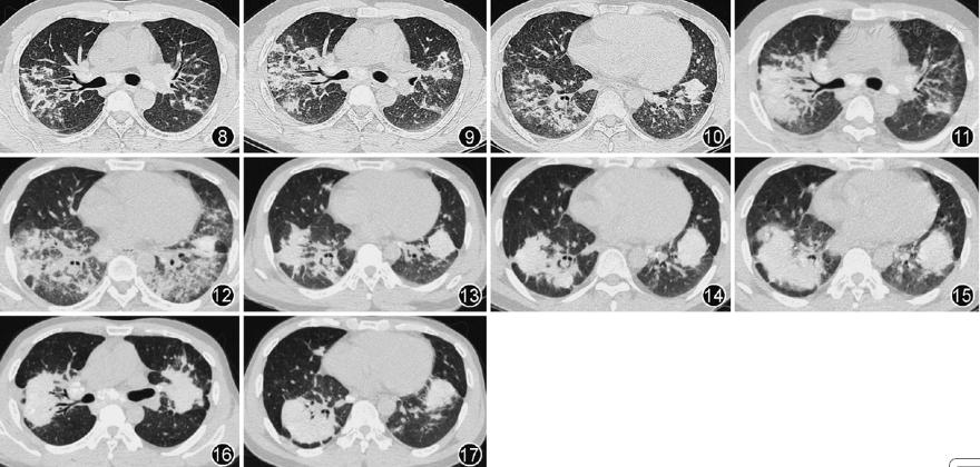 矽肺临床,急性纤维素性机化性肺炎