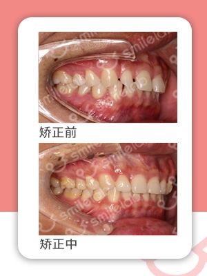 牙齿缝隙大隐形牙套矫正前后对比,牙齿前突隐形牙套矫正的全过程