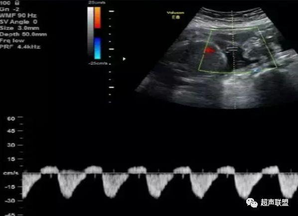 胎儿宫内窘迫如何判断,38周如何判断胎儿宫内窘迫或缺氧