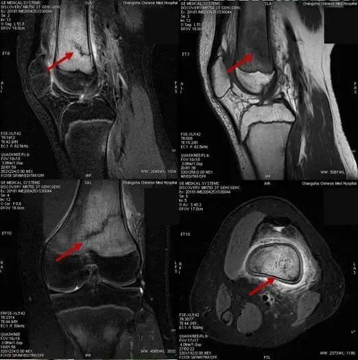 三年级学生骨折,初三开学多人骨折
