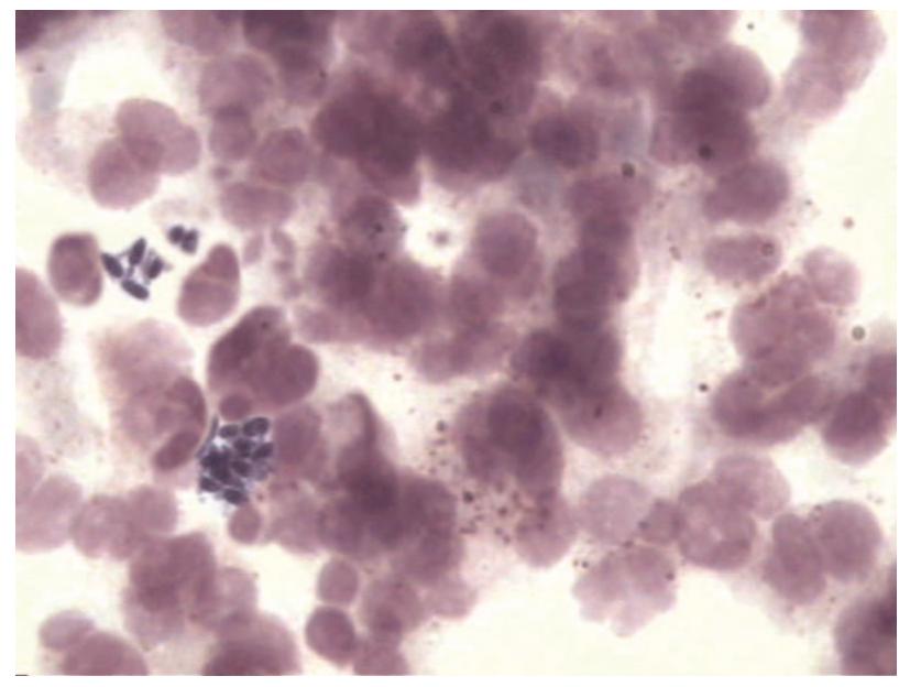 尿液中的有形成分红细胞,尿液中常见的有形成分