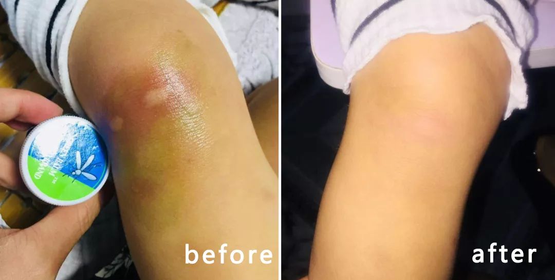 1罐搞定一整夏！20秒止痒消肿，让蚊虫再无嚣张机会