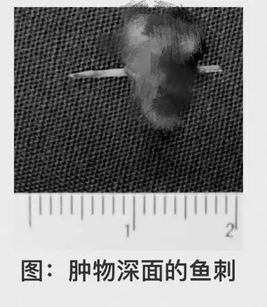 女子舌头溃疡癌变,女性舌头麻木是癌症征兆