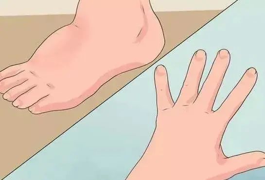 下肢总有水肿怎么回事？名中医王清海教授教你消掉水肿！