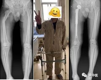 【提醒】先别悲观!骨转移瘤不是治疗的终点,此法值得被重视