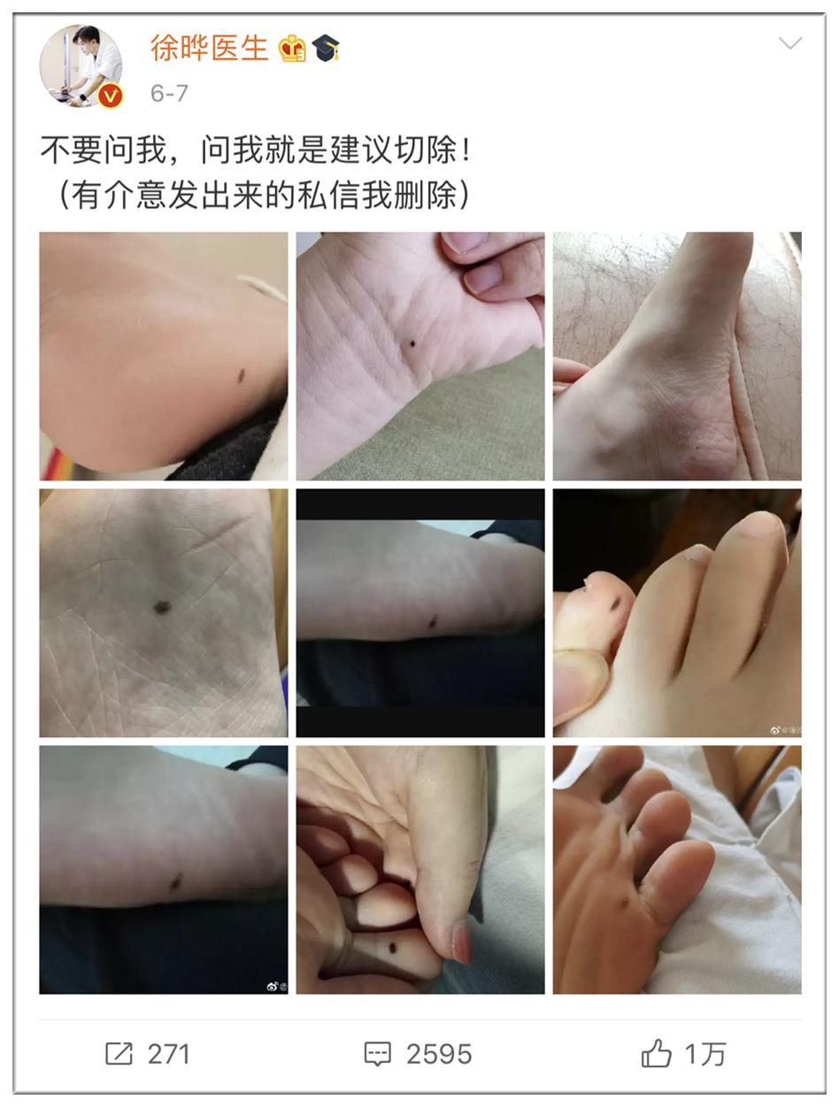 什么样的痣需要提高警惕,什么样的痣要引起重视