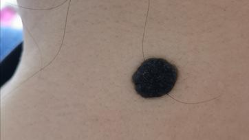 容易癌变的痣去哪里切除,从小就有的痣要切除吗