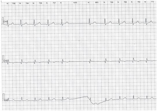 各种心律失常心电图巧记方法,常见心律失常的心电图表现与处理