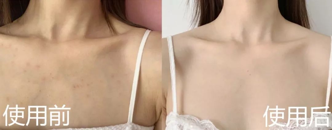 挤痘痘出来的白色长条状是什么,痘痘黑头挤出白颗粒