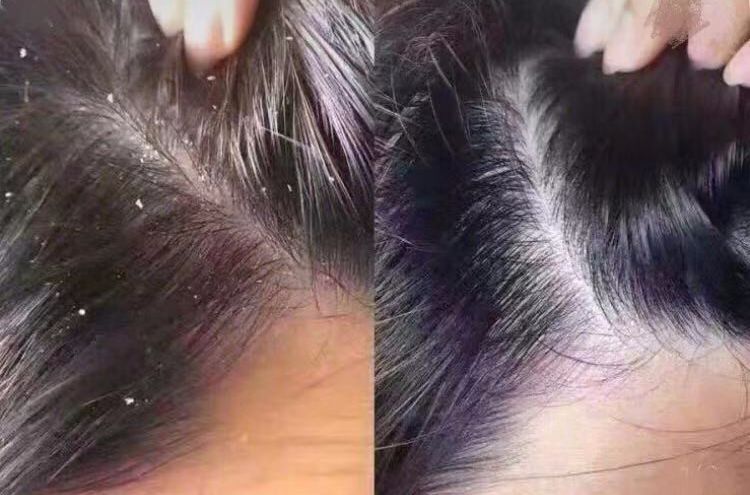 挤痘痘出来的白色长条状是什么,痘痘黑头挤出白颗粒