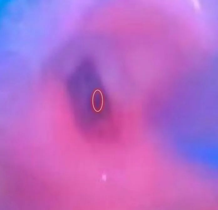 气道异物患者麻醉,小儿气道异物麻醉