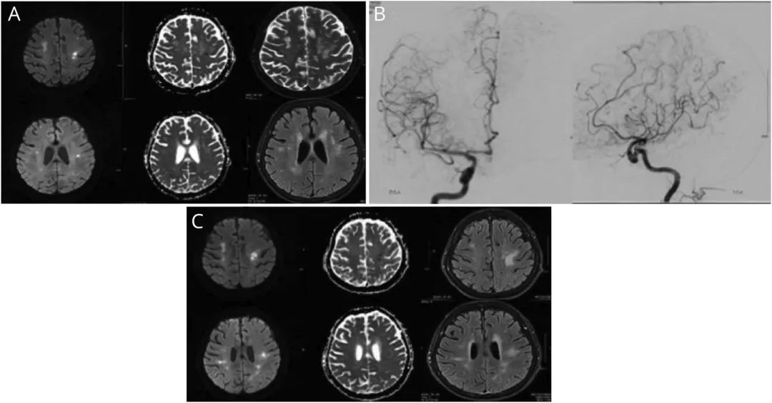 脑血管串珠样改变,脑卒中的临床及影像表现