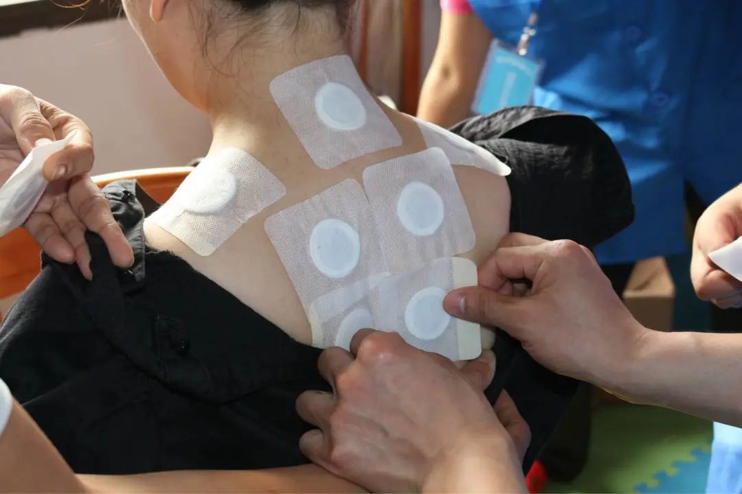 冬病夏治别错过三伏贴趁热贴起来,三伏贴入伏首日冬病夏治进行中