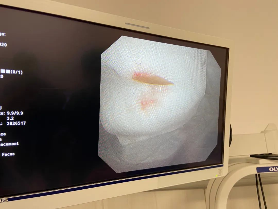 鸡骨头卡在喉咙怎么自救,鸡骨头卡在喉咙里会自己好吗