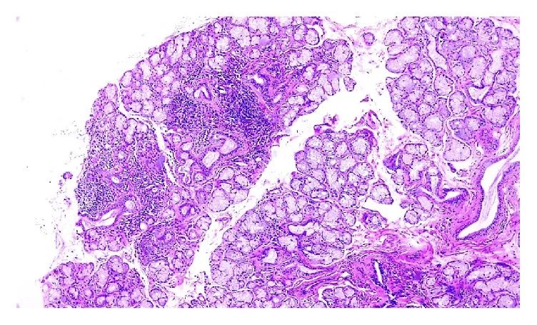 低钾性周期性瘫痪图片,低钾性瘫痪