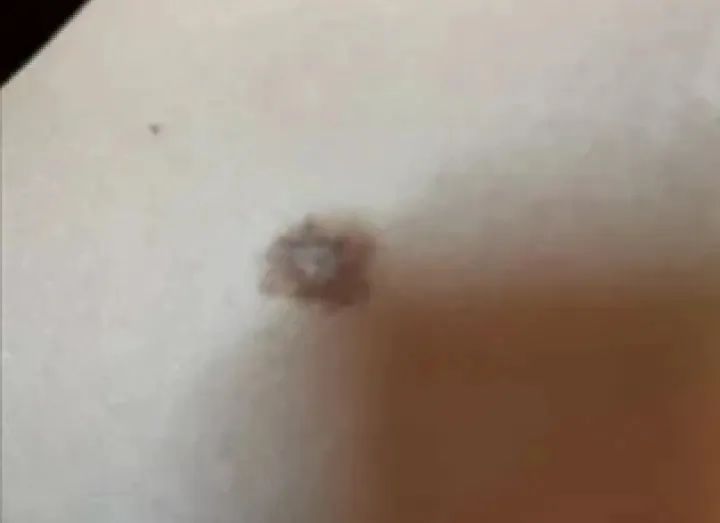 黑痣癌变的10个征兆,黑痣癌变从发病到去世不到两个月