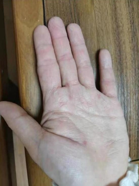 湿疹一直不退的原因是过敏吗,湿疹反复无能为力