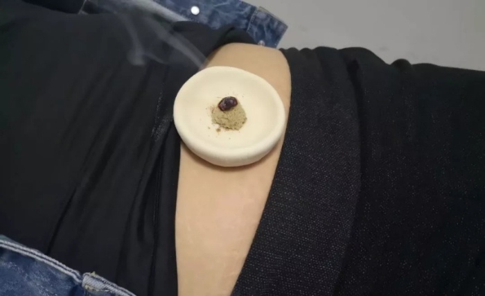 *安泰**市中医医院弘扬中医特色疗法内外兼治“月经失调”