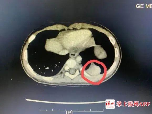 5个月宝宝咳嗽反复发烧38.5,8岁孩子反复发烧咳嗽厉害持续5天