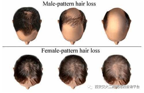 秃如其来如何拯救,秃如其来如何拯救我们的头