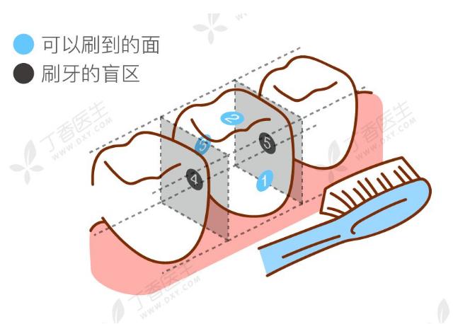 邻面龋可以变成静止龋吗,门牙邻面龋早期怎么处理