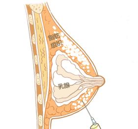 【吃惊】女子胸“跑到”腰上去了！还发生严重感染，注射过的女性赶紧注意了……