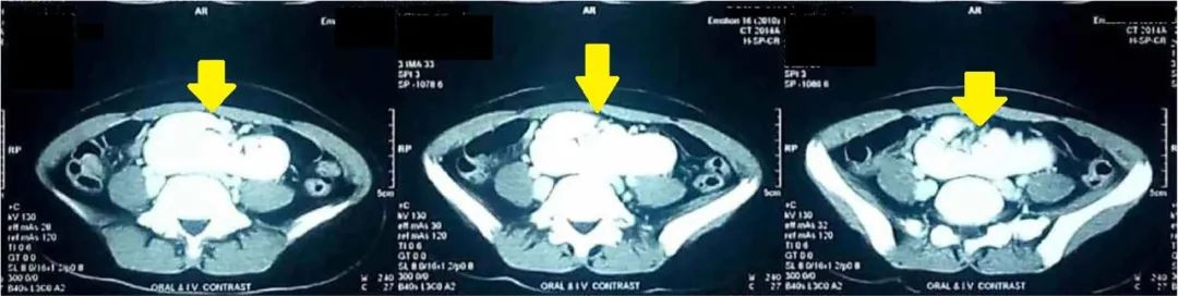 融合肾盏,融合肾与重复肾的区别