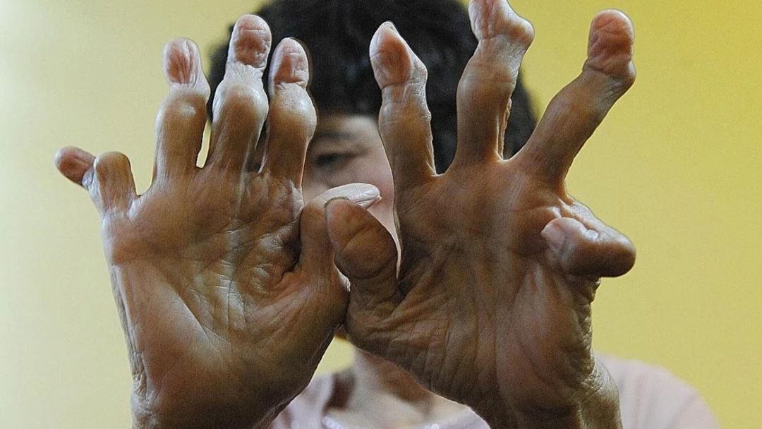 有类风湿症状没有类风湿因子,不是类风湿病吃类风湿药有啥症状