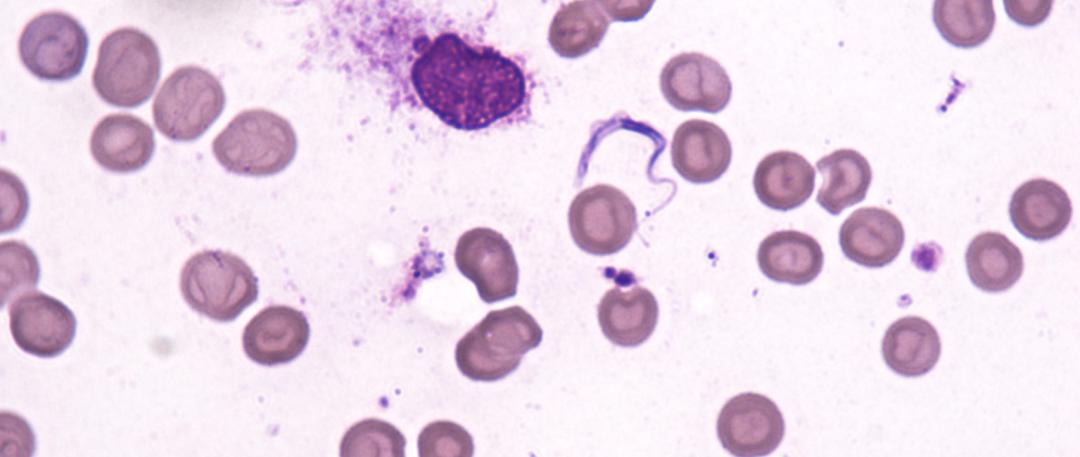 51岁老刘臀部包块不断长大,华山感染专家:是非洲来的“偷渡客”