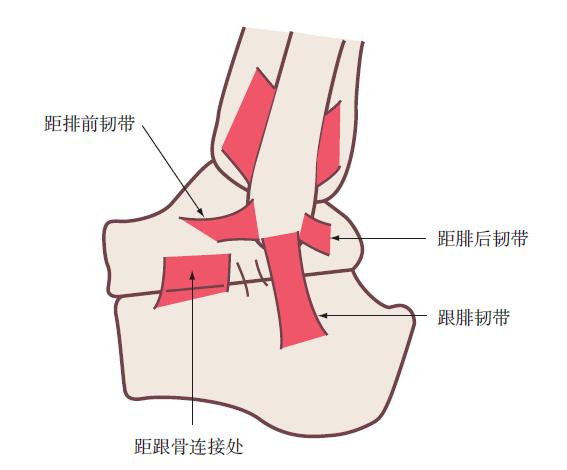 踝关节损伤的处理7条助你应对,踝关节损伤恢复的阶段表现发痒