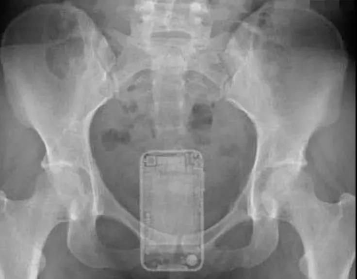 杯具！泸州男子竟将啤酒玻璃杯塞进肛门？塞入直肠的奇……