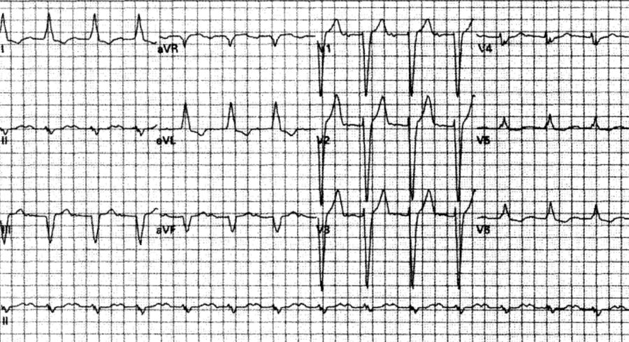 室速全名叫什么,室速的解读和识别