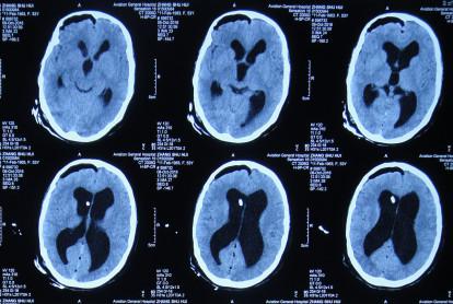 脑积水腹腔分流术后头晕头痛,脑积水分流术后发烧会有什么后果