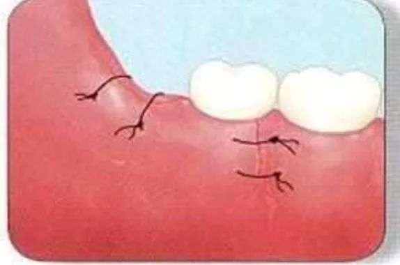 智齿组图,智齿大全