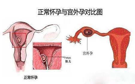 被遗忘在女人体内的「节育环」，该取出来了。