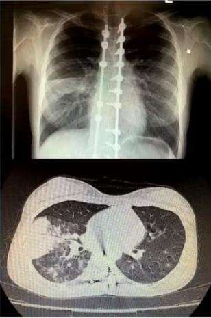 成人肺炎支原体肺炎诊治专家共识,2023肺炎支原体感染中药诊治指南