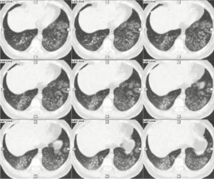 成人肺炎支原体肺炎诊治专家共识,2023肺炎支原体感染中药诊治指南
