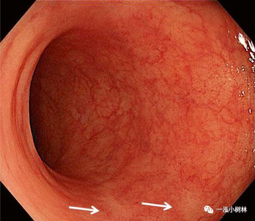 炎症性肠病内镜下表现,炎症性肠病早期筛查结果