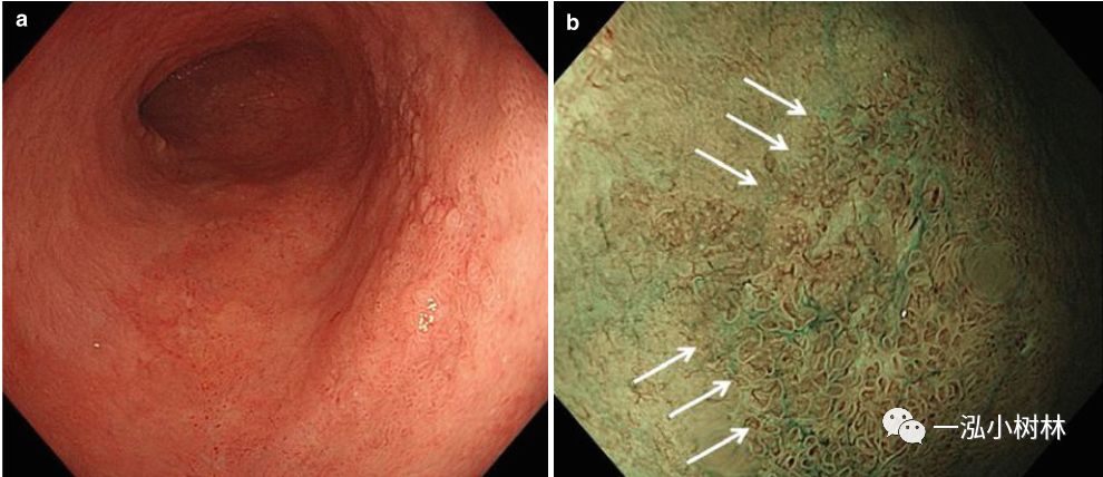 炎症性肠病内镜下表现,炎症性肠病早期筛查结果