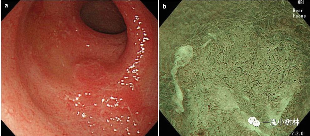 炎症性肠病内镜下表现,炎症性肠病早期筛查结果