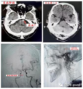 【医疗动态】甘肃省中医院脑病介入科成功拉栓两例高危心源性栓塞患者
