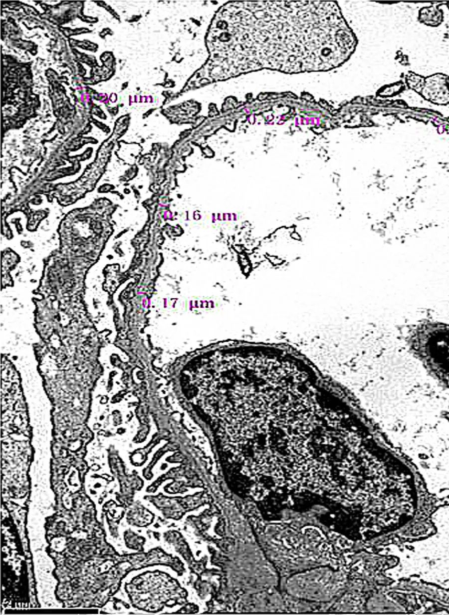 薄基底膜肾病和iga肾病区别,膜性肾病IgA肾病