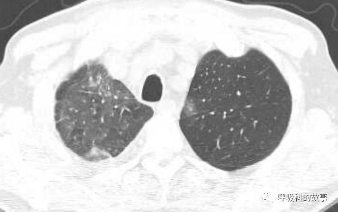 我是如何诊治肺炎的？（4）——如何理解抓住关键信息（2）